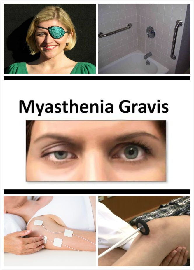 Myasthenia Gravis Diagnosis  New Health Advisor