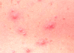 What does Chickenpox Look Like? | New Health Advisor
