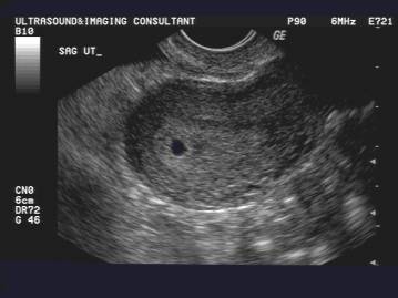 What to Expect for Ultrasound at 4 Weeks: Pictures and ...