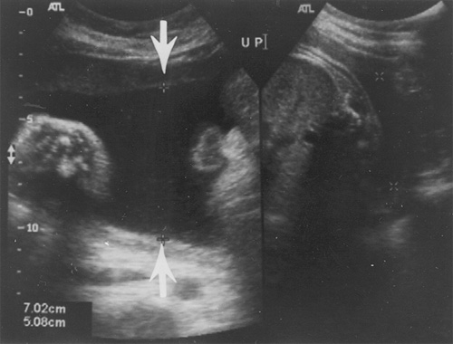 Oligohydramnios Definition with Ultrasound Pictures and ...