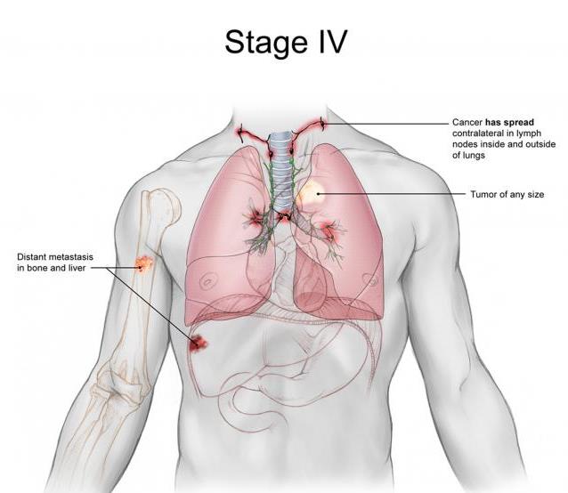 Last-Stage Lung Cancer: Sign, Treatment and Life ... pneumonia patient diagram 